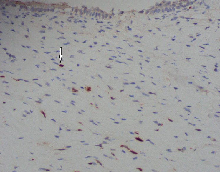 Vagina, hypoxia-inducible factor-1α protein detection by immunohistochemistry - diaminobenzidine chromogen and haematoxylin counterstained, ×400. Nuclear staining within positive stromal cells (arrow).